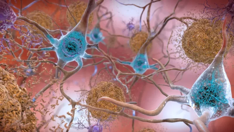 Alzheimer: em feito importante, medicamento consegue retardar progressão da doença