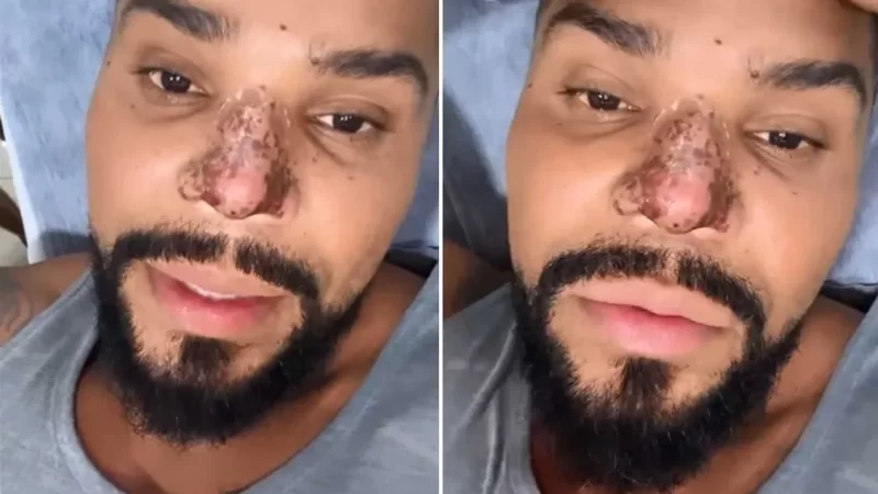 Naldo Benny sofre princípio de necrose no nariz após procedimento estético